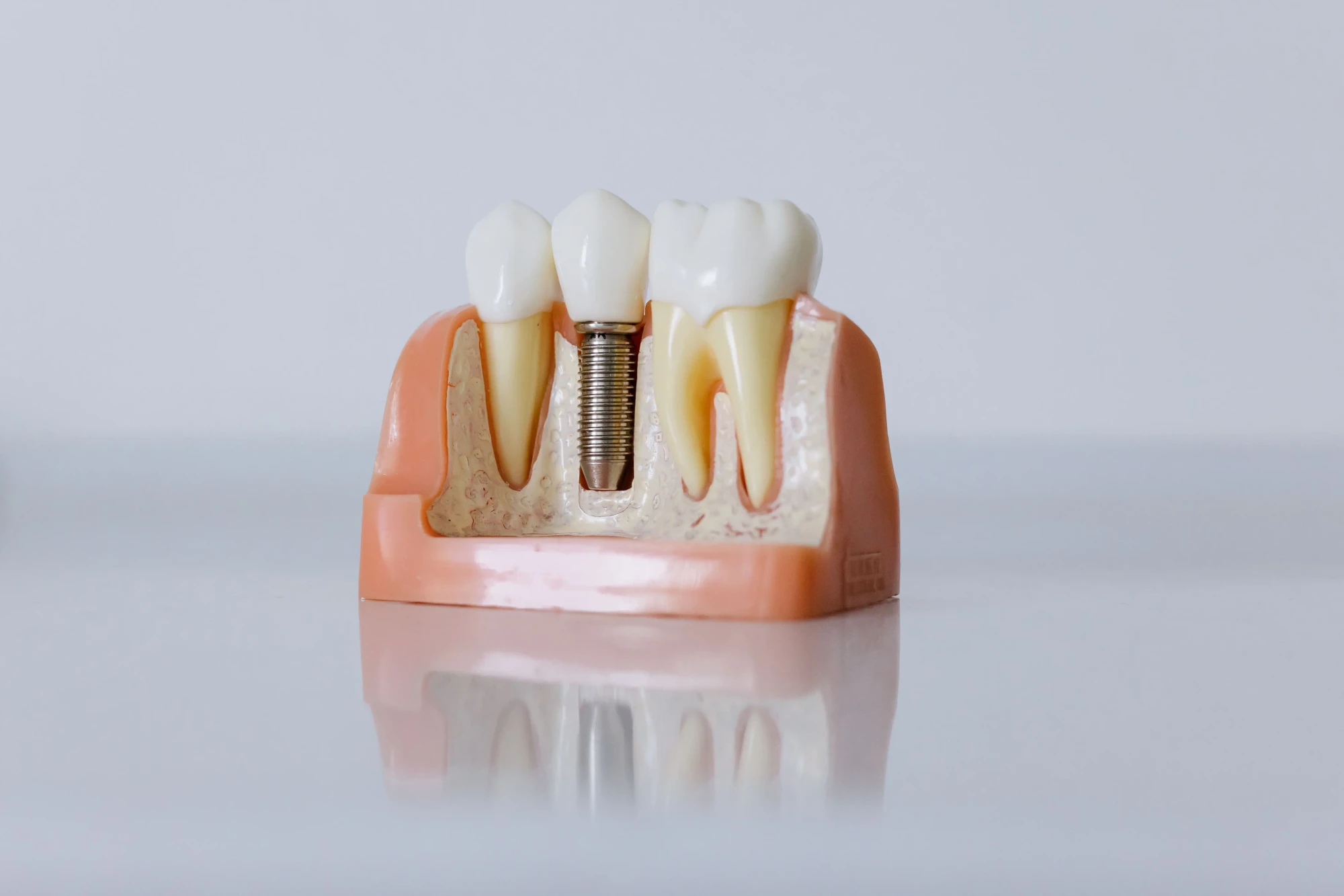 Implantologie – Brașov, implant dentar din titan
