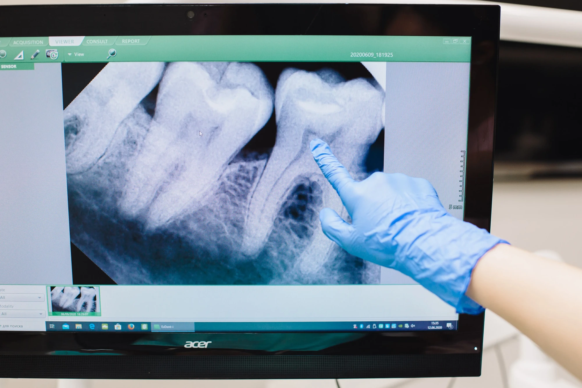 Radiologie – Brașov, radiografie dentară digitală